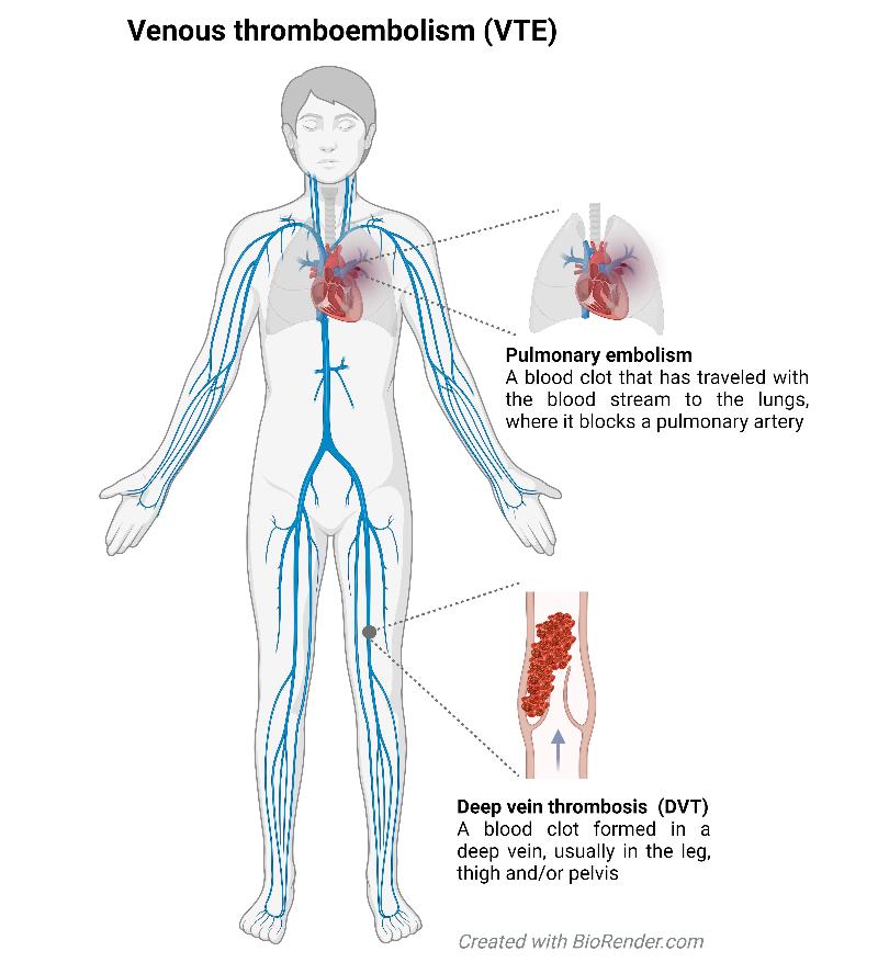 VTE figure overview english.jpeg Venous thromboembolism